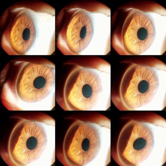 This condition is called Iridodonesis,